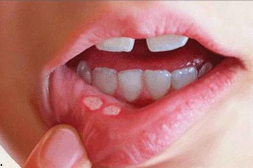 吃瓜导致口腔溃疡,口腔溃疡的“吃瓜”成因揭秘